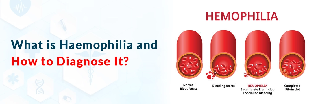  What is Haemophilia and How to Diagnose It?